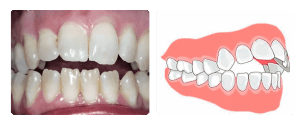 открытый прикус