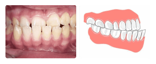 мезиальный прикус