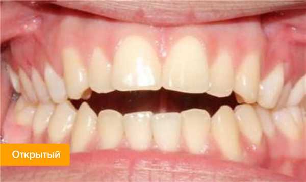Фото открытого прикуса