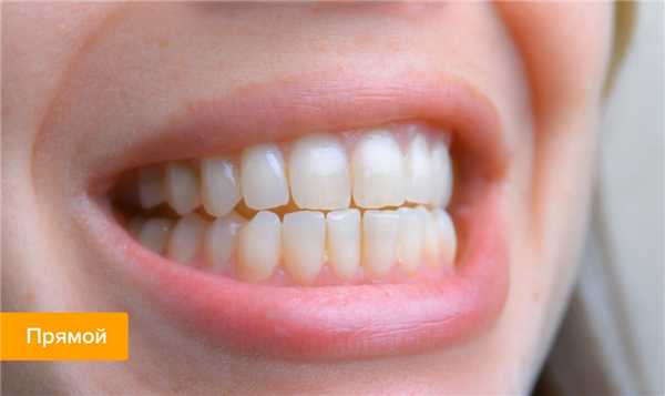 Фото прямого прикуса