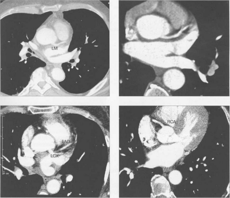 МСКТ-коронарограммы. Поперечные срезы.