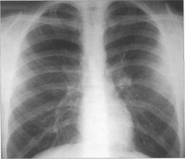 Рентгенограмма грудной клетки подростка. Передняя проекция.