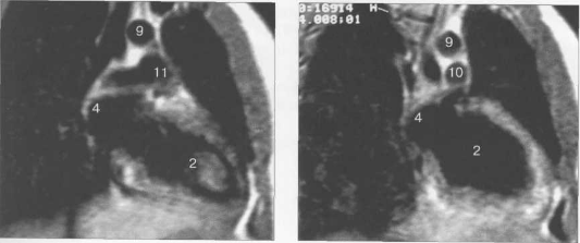 МРТ сердца. Двухкамерные сечения.