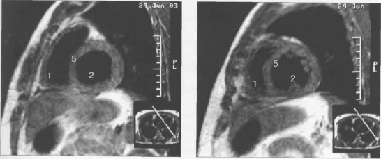 МРТ сердца. Сечения по короткой оси левого желудочка.