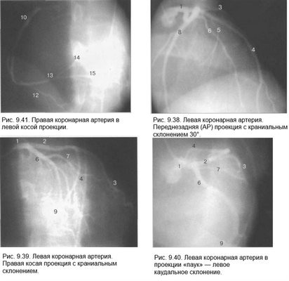 левая коронарная артерия