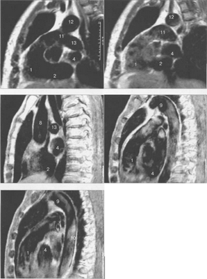 MPT сердца. Сагиттальная плоскость.