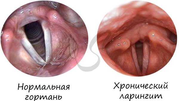 Хронический ларингит