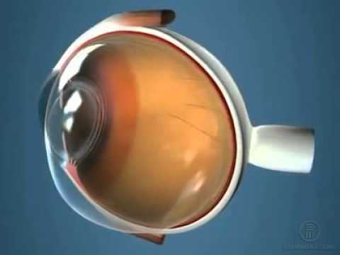 Видео Стекловидное тело - строение и функции, симптомы и болезни