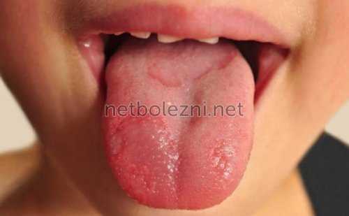 Проявление болезни во рту