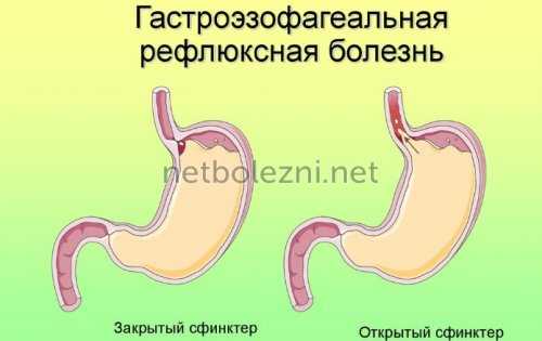 Сфинктер при ГЭРБ