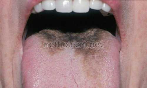 Налет черного цвета