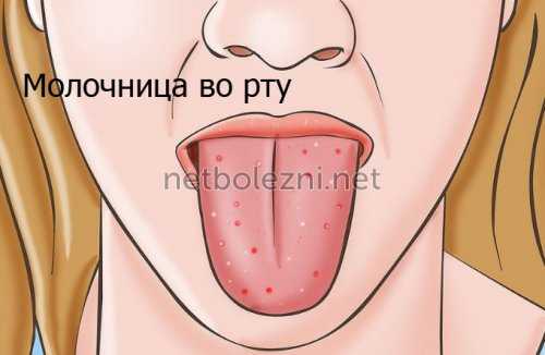 Молочница во рту