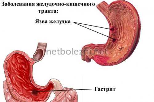 Заболевания желудочно-кишечного тракта