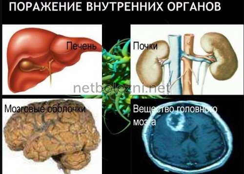 Поражение внутренних органов