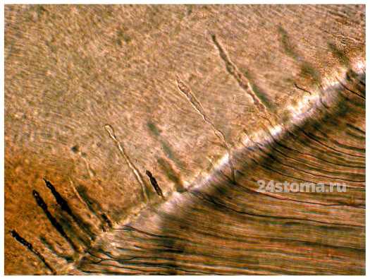 Эмалевые веретена (дентинные канальцы, проникающие в зубную эмаль)