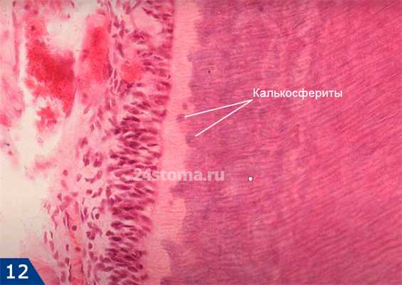 Глобулярный и интерглобулярный дентин (гистология)