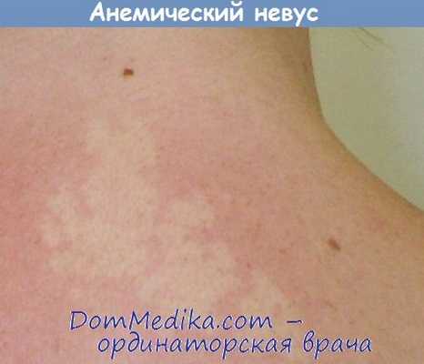 анемический невус