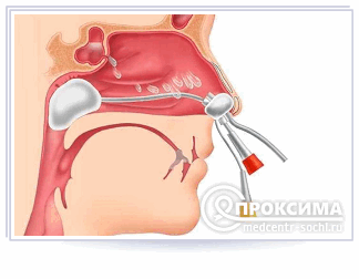 Пункция верхнечелюстной пазухи с введением катетера с одной стороны
