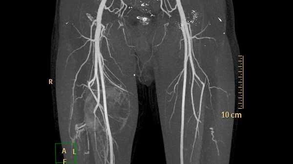 Флебография