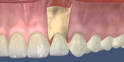 Резекция верхушки корня зуба