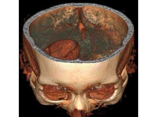 3D-реконструкция объёмного образования правой лобной доли головного мозга, выполненная на основании сканов КТ с контрастным усилением