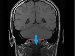 Задняя краниовертебральная декомпрессия с реконструкцией задней черепной ямки у пациента с Мальформацией Киари I типа