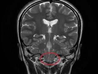 Мальформация Киари