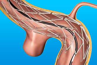 Стентирование аневризмы