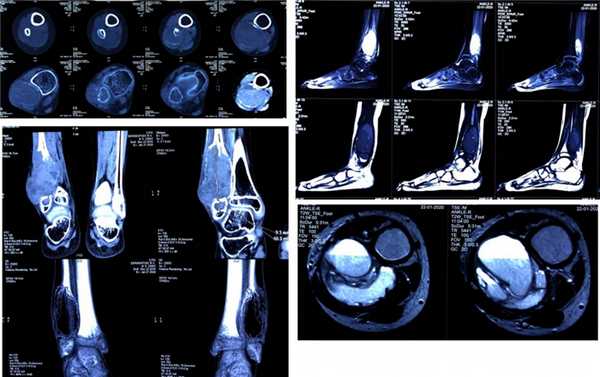 Агрессивная аневризмальная киста с выраженной митотической активностью н/3 правой малоберцовой кости.