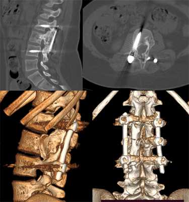 киста позвоночника после операции