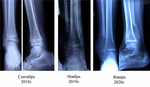Агрессивная аневризмальная киста с выраженной митотической активностью н/3 правой малоберцовой кости.