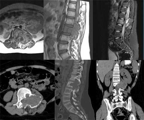 киста кости позвоночника.jpg