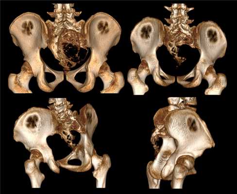 Костная киста позвоночника на МРТ