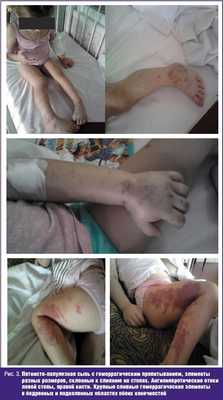 Пятнисто-папулезная сыпь с геморрагическим пропитыванием, элементы разных размеров, склонные к слиянию на стопах