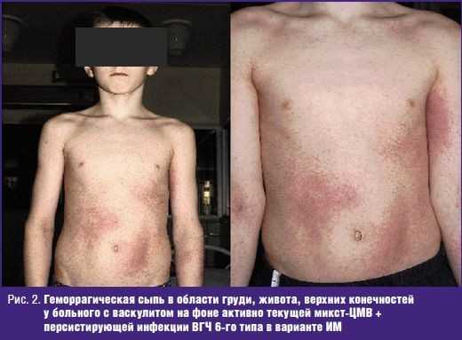 Геморрагическая сыпь в области груди