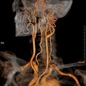 КТ-ангиография сосудов головы и шеи