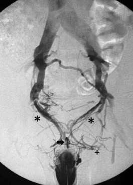 Патологический венозный дренаж из члена