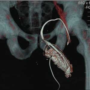 Компьютерная кавернозография