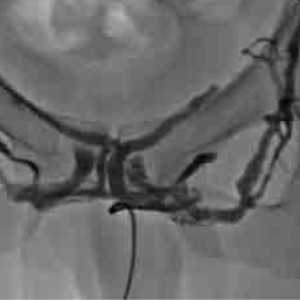 Дорсальная флебография вен полового члена