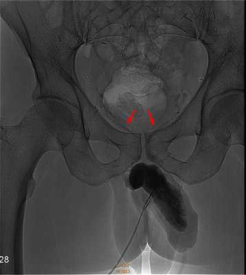 Кавернозография (стрелкой показаны утечки)