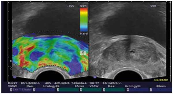 Эластография: мультифокальный РПЖ