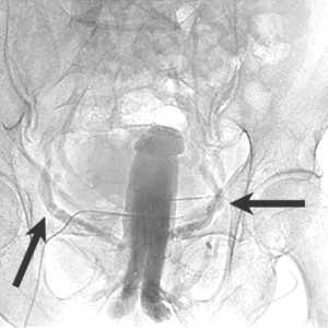 Кавернозография - венозные утечки из эрегированного члена