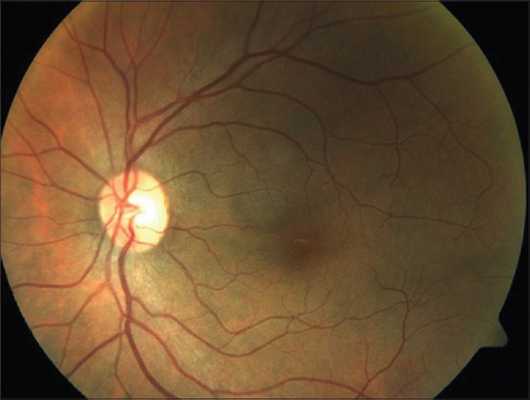 симптомы ангиопатии сетчатки