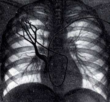 Рис. 3. Концевая ангиопульмонография. Катетер (виден под ключицей, вдоль позвоночника и в области сердца) введен в верхнесегментарную артерию верхней зоны правого легкого. Видны концевые артериальные разветвления. Контрастированы пути венозного оттока данного сегмента