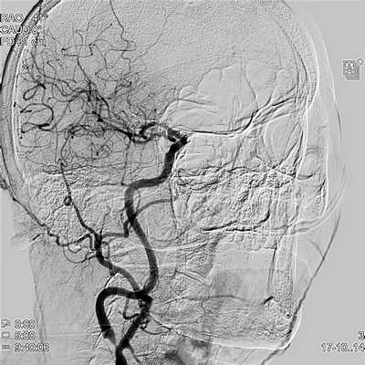 Ангиография сонных артерий - сужение внутренней сонной артерии