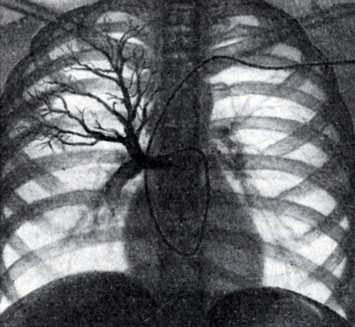 Рис. 2. Селективная ангиопульмонография. Катетер (виден под ключицей, вдоль позвоночника и в области сердца) введен в верхнезональную артерию правого легкого. Видны контрастированные сосуды верхней зоны