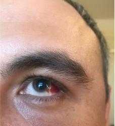 внесуставные проявления бодезни Бехтерева