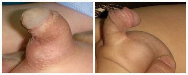 Искривление полового члена