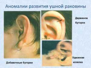 Аномалии развития наружного уха