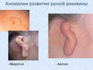 Аномалии развития наружного уха
